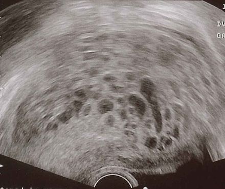 Моларна (гроздовидна) бременност